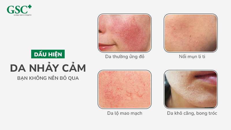 Dấu hiệu da nhạy cảm bạn không nên bỏ qua