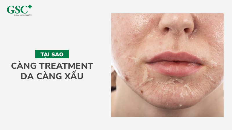 Tại sao càng treatment da càng xấu?