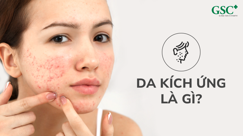 Da kích ứng tại là gì