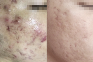 Mesotherapy mụn sần, mụn viêm