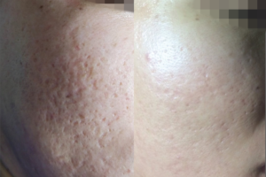 Tách đáy và laser sẹo