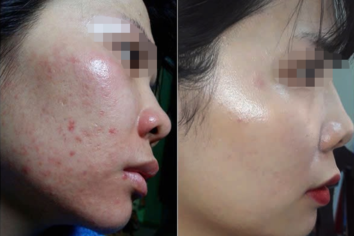 Oxy jet & điện di phục hồi corticoid