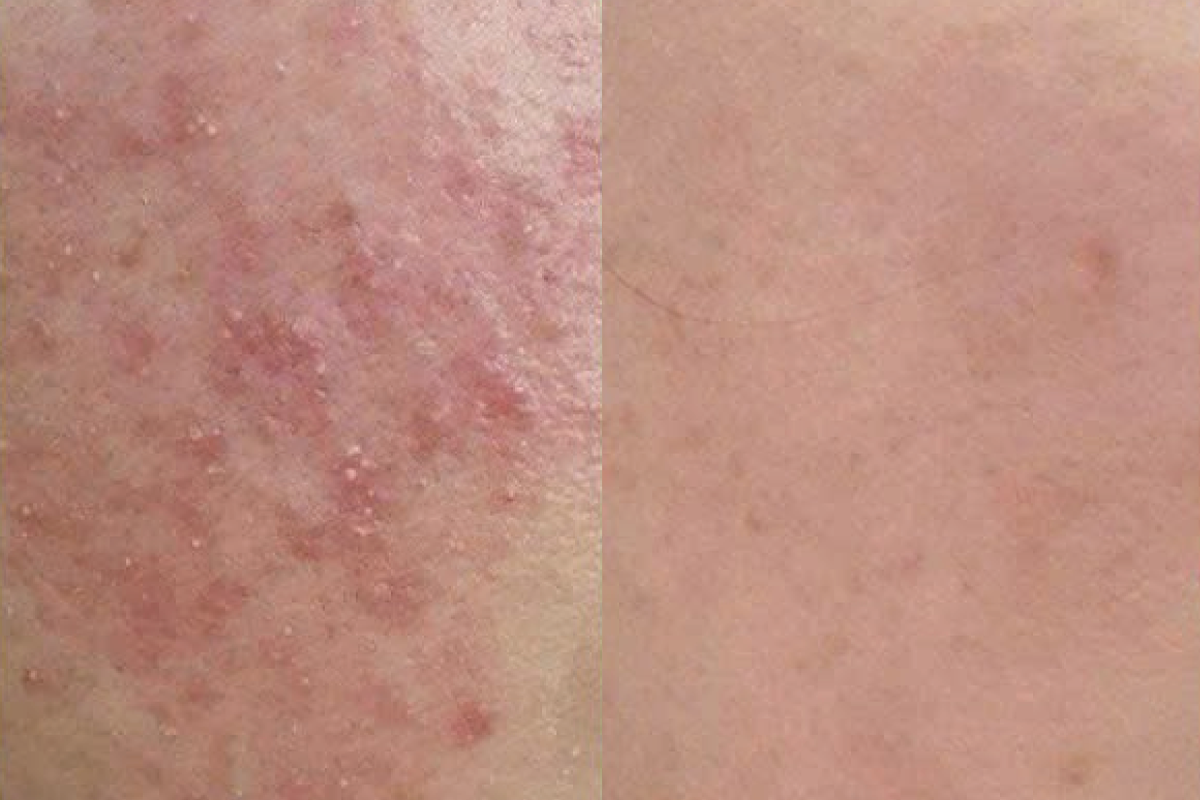 Oxyjet & ánh sáng phục hồi kích ứng