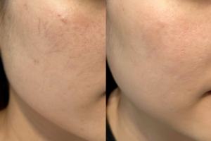 Điện di phục hồi