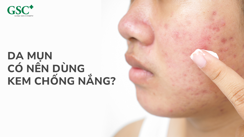 Da mụn có nên dùng kem chống nắng