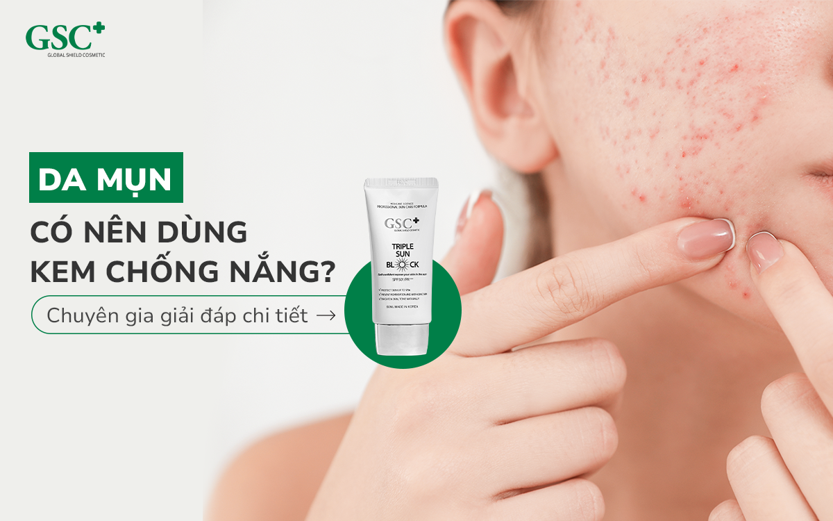 Da mụn có nên dùng kem chống nắng