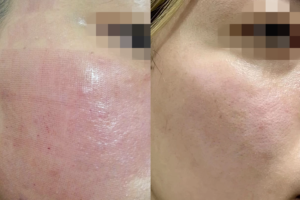 Điện di & ánh sáng phục hồi sau laser