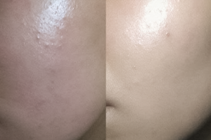 Điện di & ánh sáng với mụn viêm