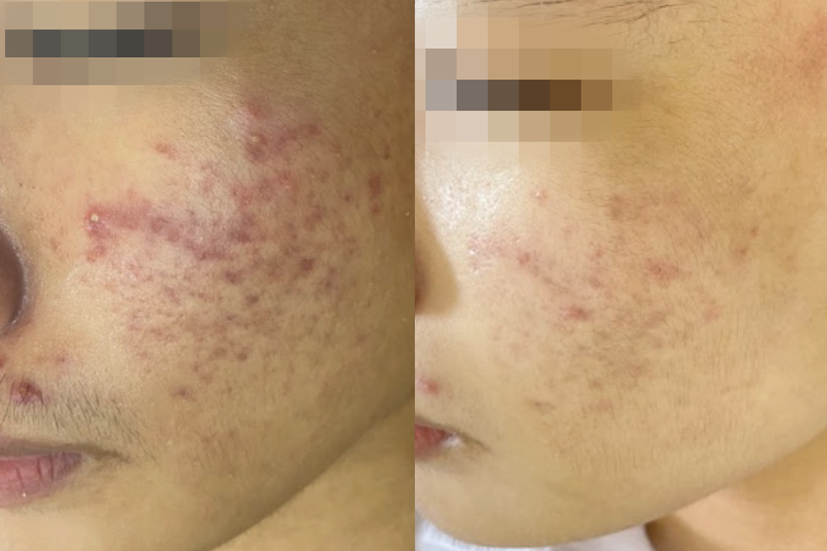 Điện di & ánh sáng với mụn trứng cá