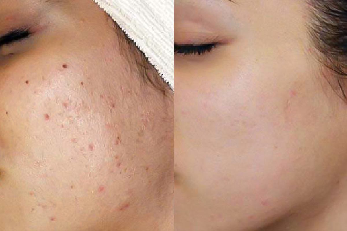 Vi kim sinh học mụn sần