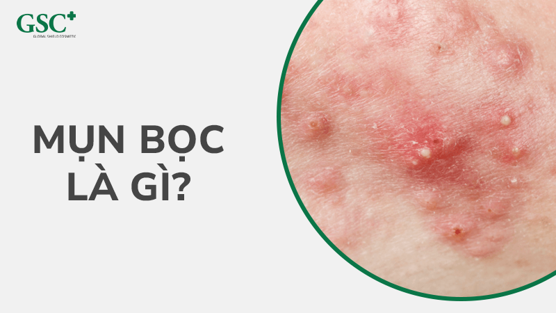 Mụn bọc là gì
