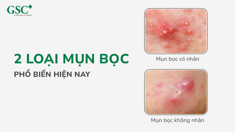 2 nhóm mụn bọc phổ biến hiện nay