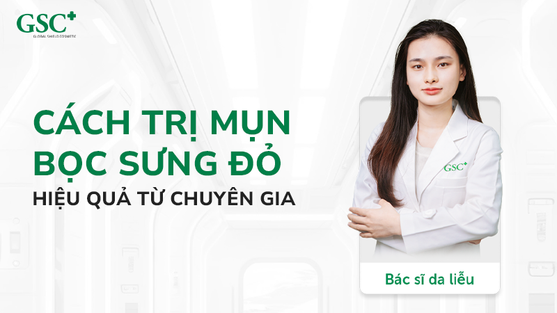 Cách trị mụn bọc sưng đỏ hiệu quả từ chuyên gia