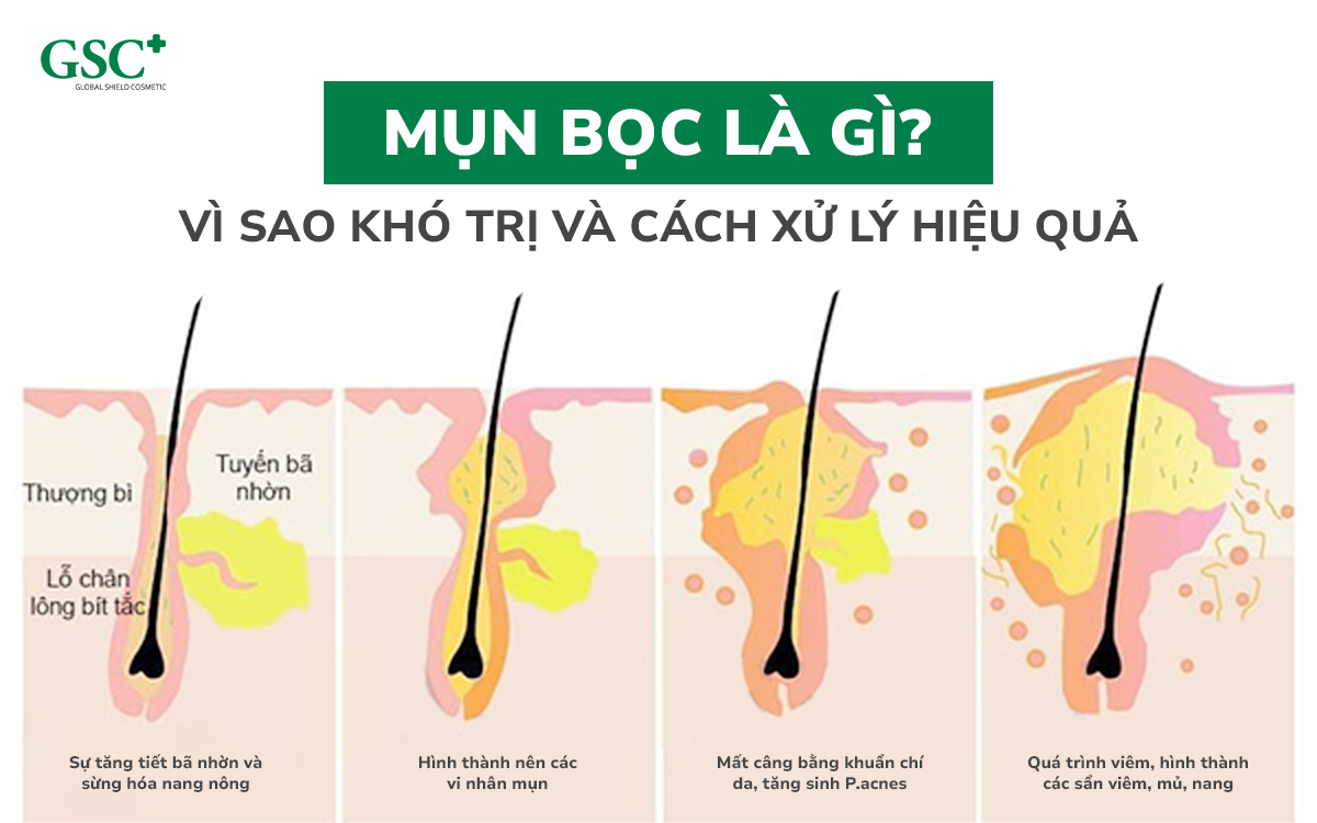 Mụn bọc là gì