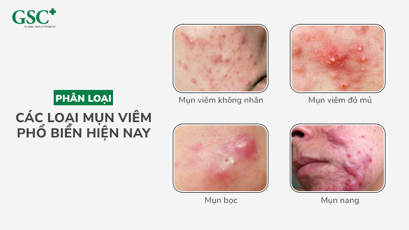 Phân loại các loại mụn viêm