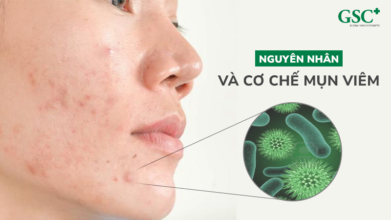 Mụn viêm là như thế nào? Nguyên nhân và cơ chế