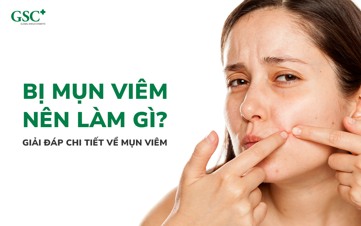 Bị mụn viêm nên làm gì