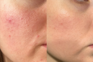 Mụn nhân viêm nhẹ