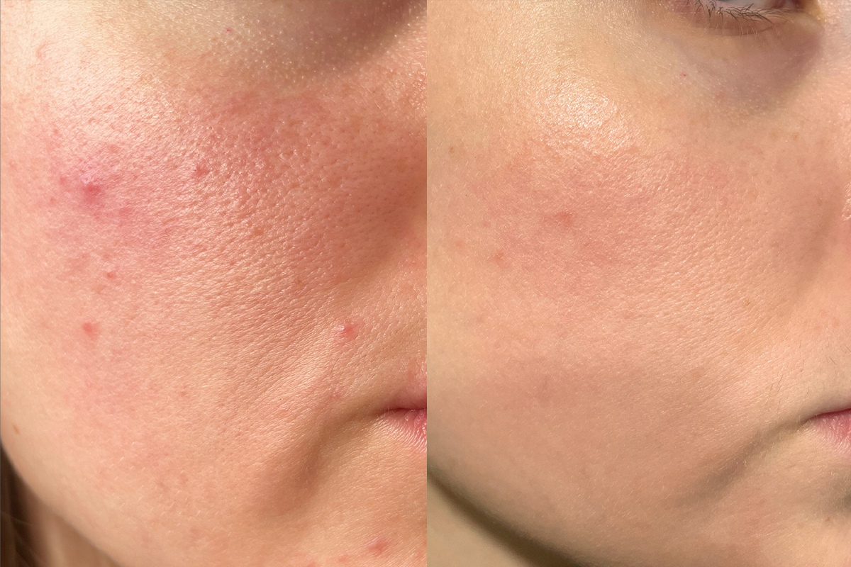 Mụn nhân viêm nhẹ