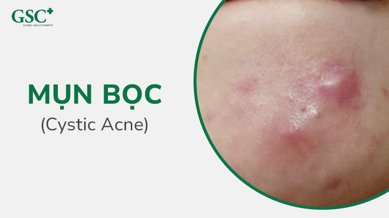 Mụn bọc (Cystic Acne)