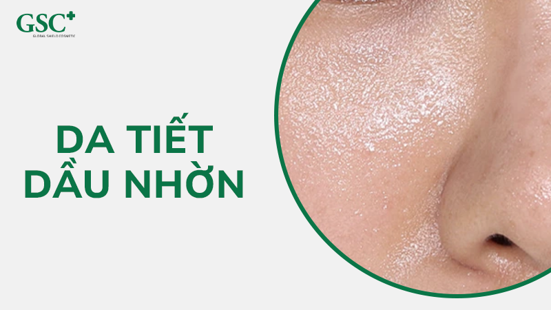 Da tiết nhiều dầu nhờn
