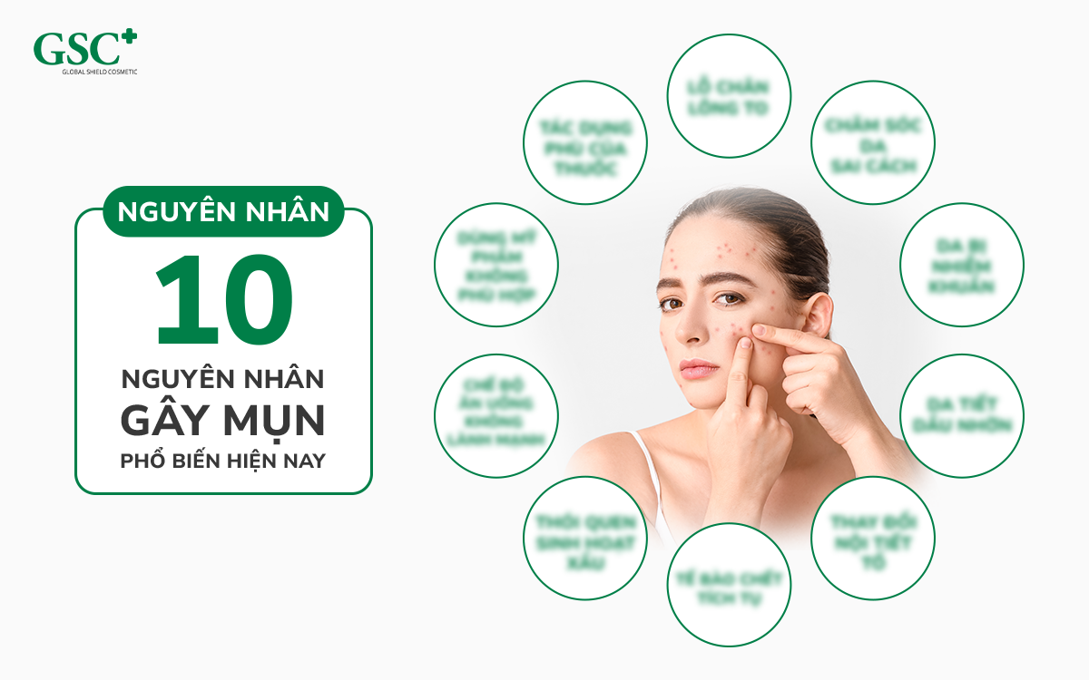 nguyên nhân gây mụn