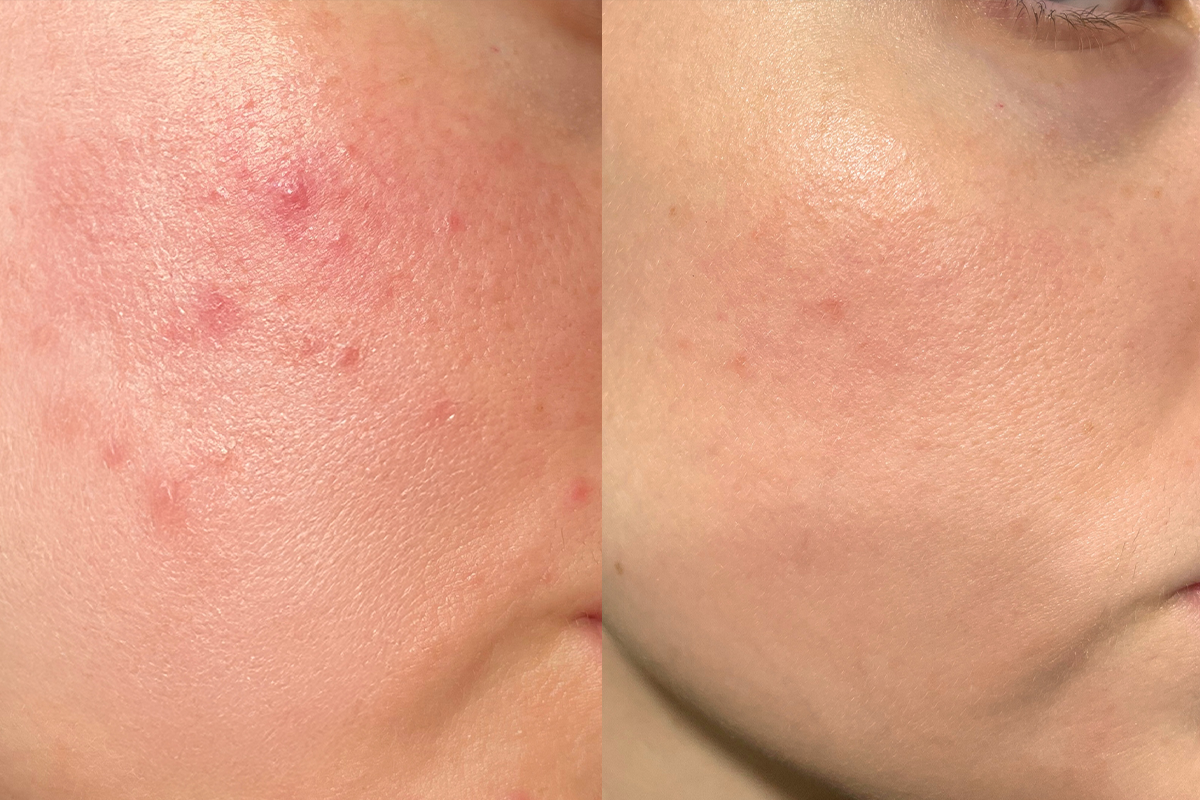 Mụn nhân, mụn sần viêm nhẹ