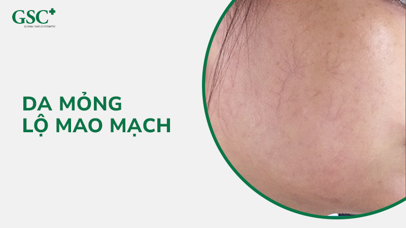 Da mỏng lộ mao mạch là sao