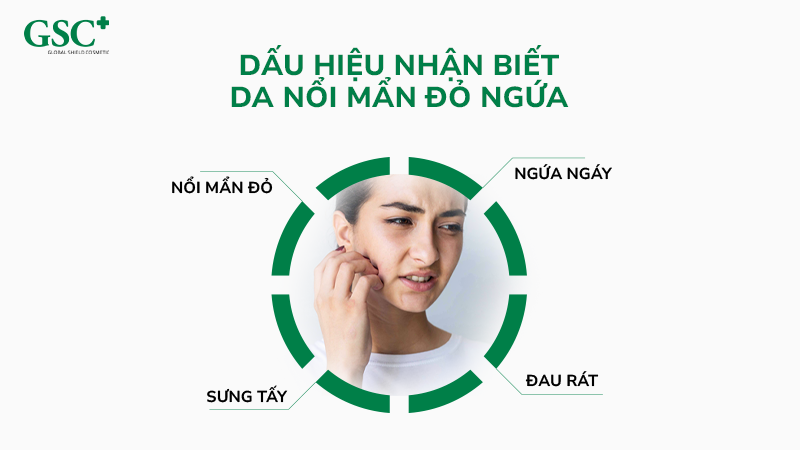 Dấu hiệu nhận biết da nổi mẩn đỏ ngứa