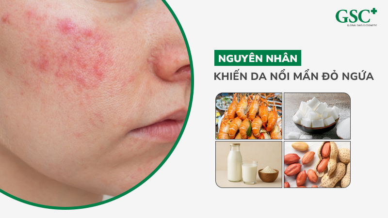 Nguyên nhân khiến da nổi mẩn đỏ ngứa