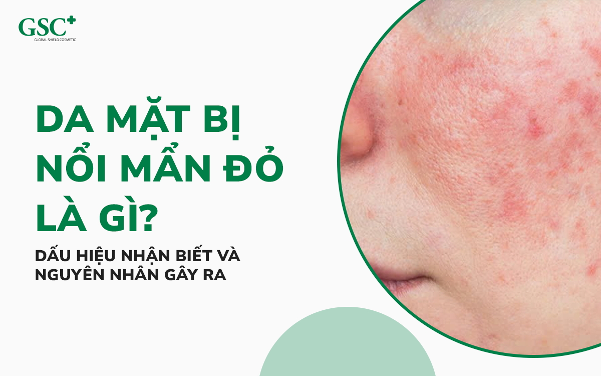 Da mặt bị nổi mẩn đỏ