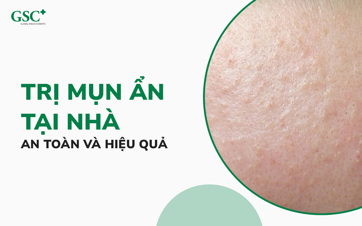 cách trị mụn ẩn tại nhà