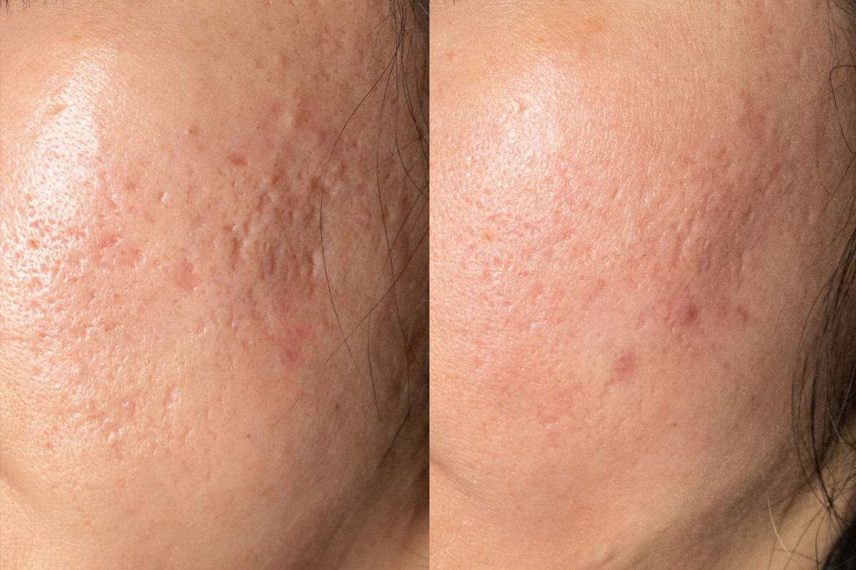 Sẹo lòng chảo, đáy hộp