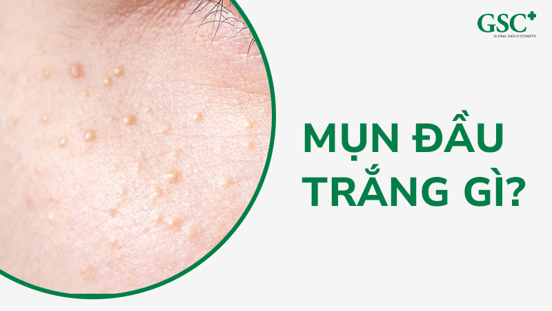 Mụn đầu trắng khái niệm