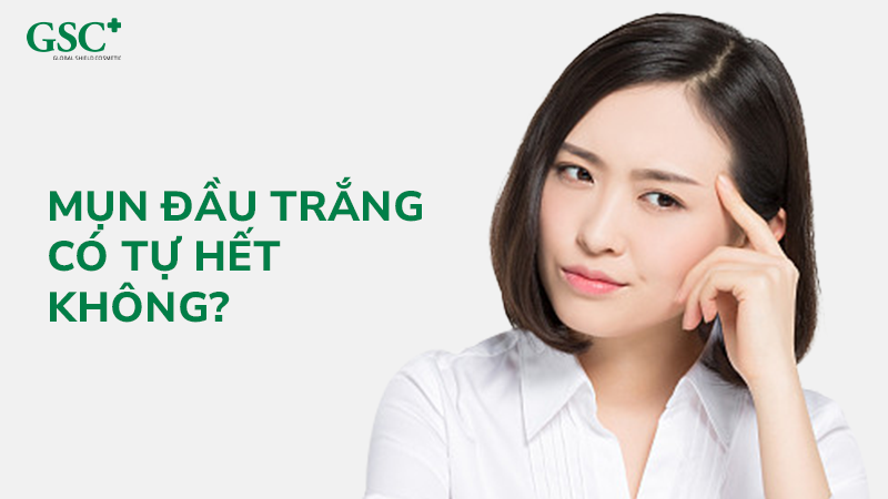 Mụn đầu trắng có tự hết không