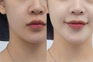 Phi nano căng bóng, trắng sáng