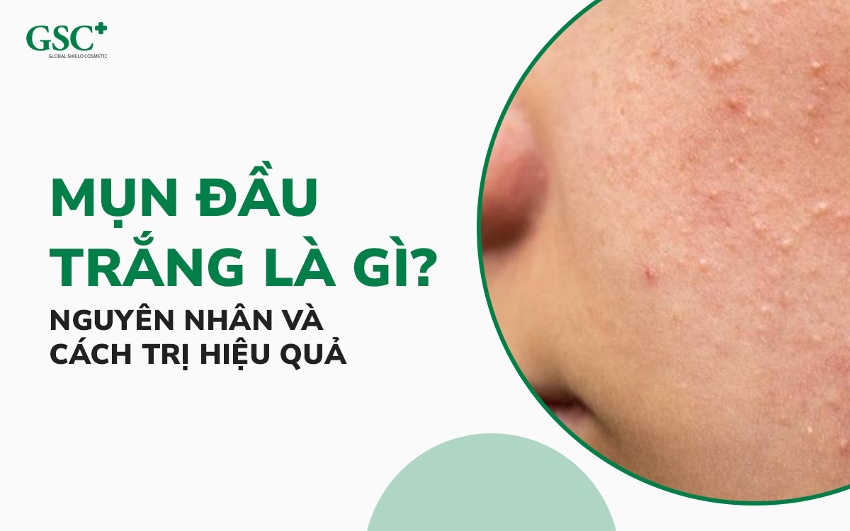 Mụn đầu trắng là gì?