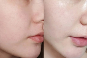 Căng bóng trẻ hóa