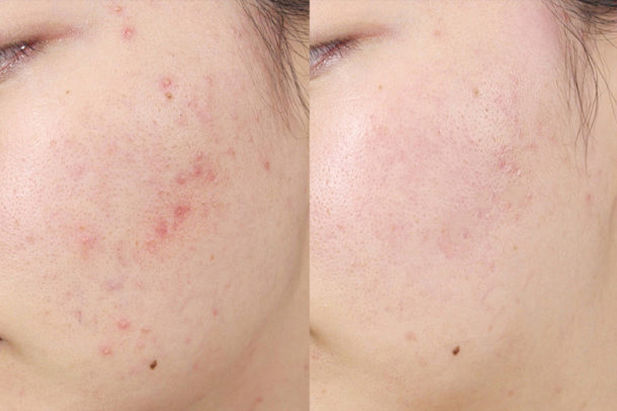 Peel hóa học mụn sần, mụn trứng cá