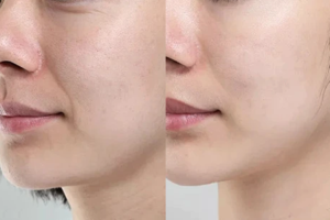 Lăn kim phi kim căng bóng