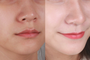 Ủ trắng căng bóng