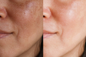 Nám thượng bì & nám hỗn hợp