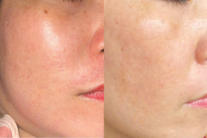 Phục hồi da corticoid