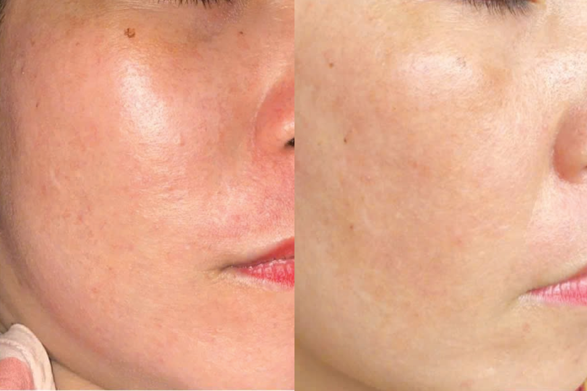 Phục hồi da corticoid