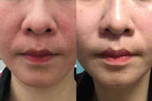 Da kích ứng mẩn đỏ