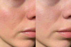 Phục hồi sau laser