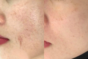 Phục hồi da mỏng yếu