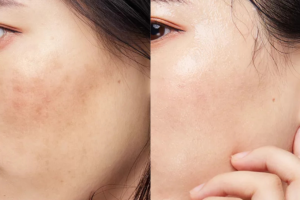 Peel hóa học nám