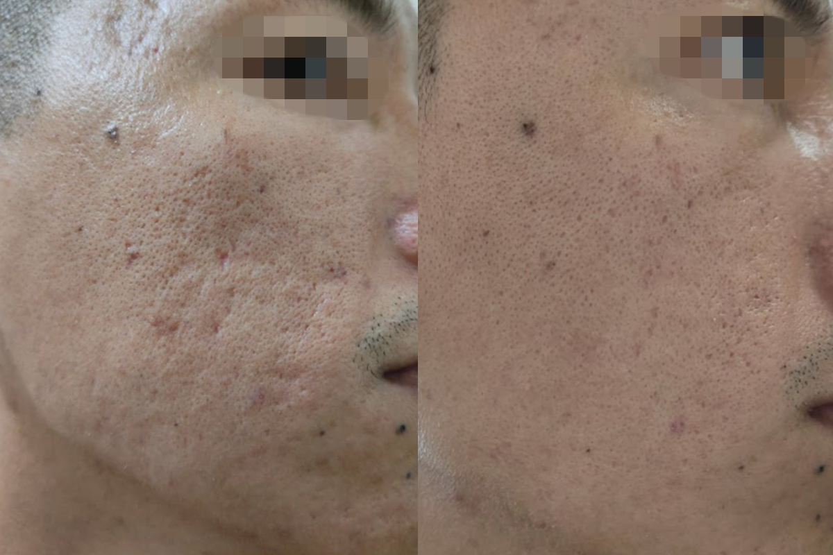 Tách đáy và phi kim sẹo