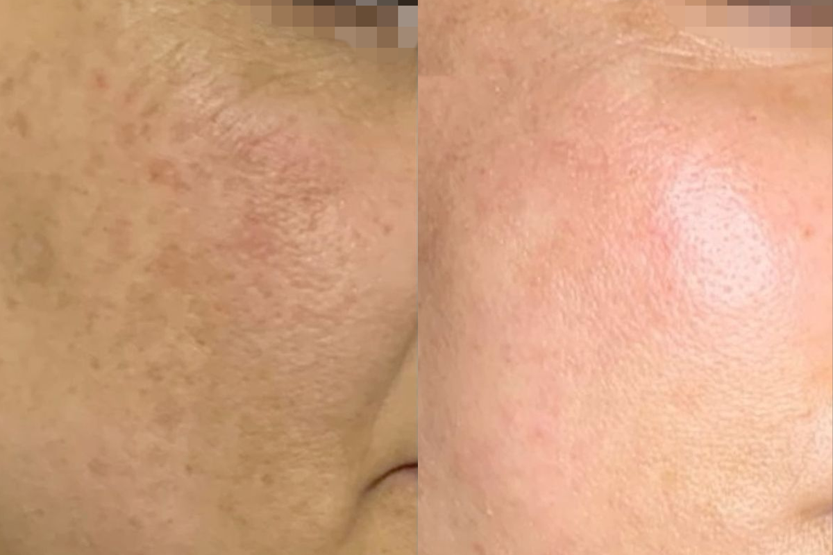 Lăn kim phi kim nám